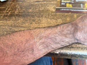 Erythemal response to the strong TN sun! 6-18-25